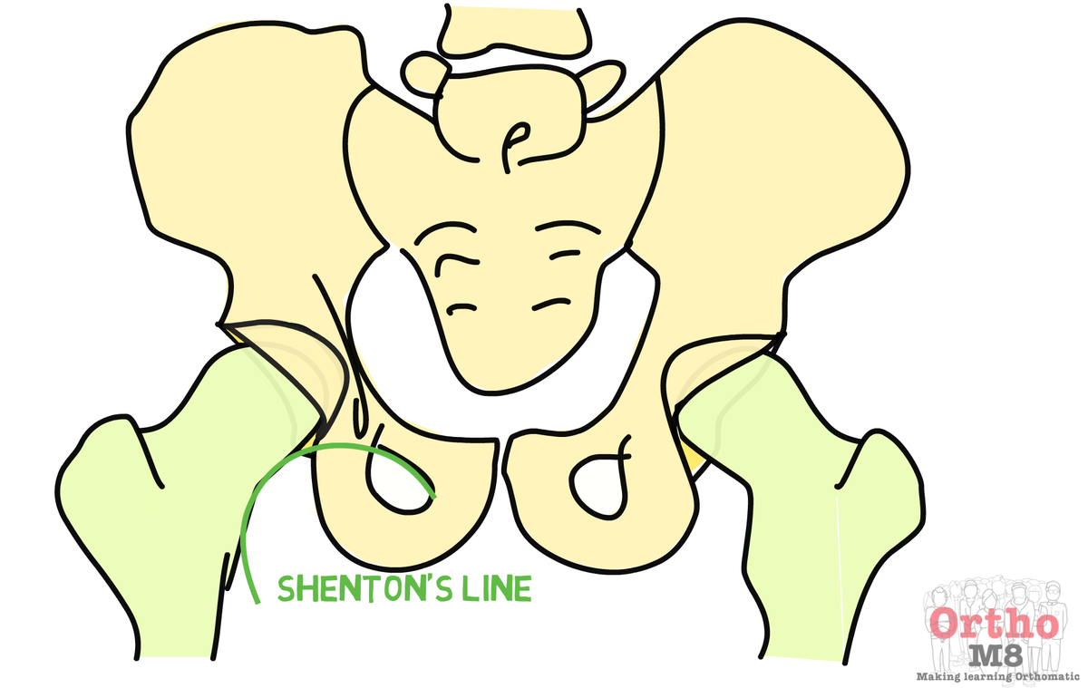 Diagnosis of a hip fracture