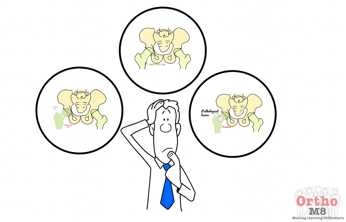 Atypical hip fractures