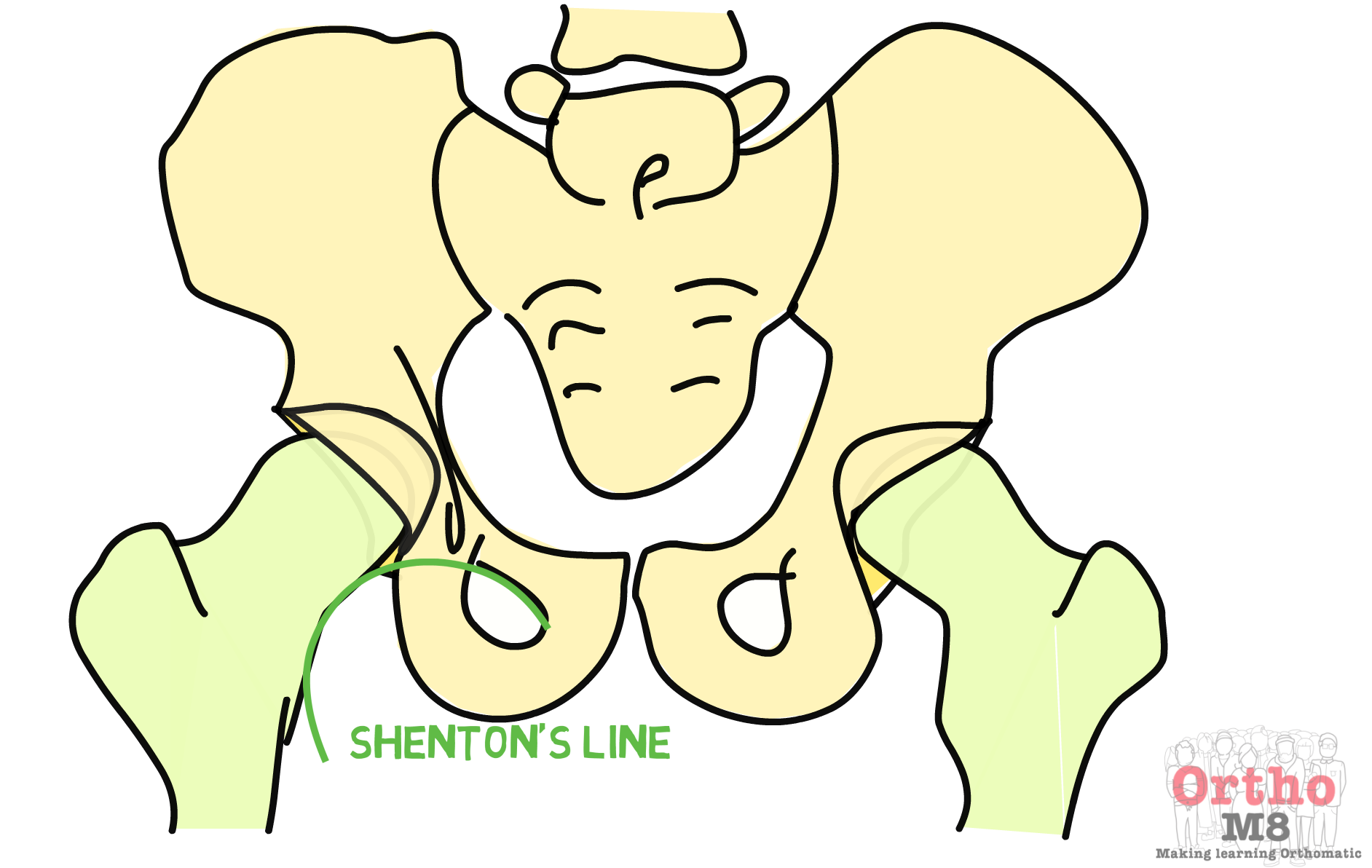 Diagnosis of a hip fracture